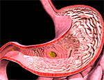 Древнейшая болезнь человека – язва желудка