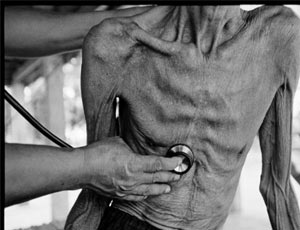 Крымчане в опасности: их  заражают  туберкулёзом приезжающие на лечение