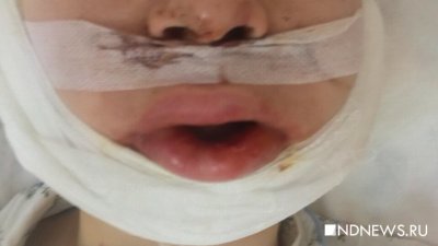 В Ленобласти школьнице сломало челюсть во время взрыва баллончика