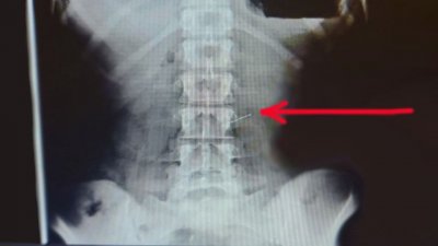 Случай с рукодельницей: подмосковные врачи вытащили из желудка женщины булавку