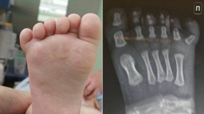 Подмосковные врачи прооперировали ребенка с шестью пальцами на ноге