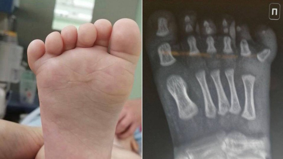 Подмосковные врачи прооперировали ребенка с шестью пальцами на ноге