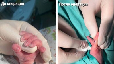 Подмосковные хирурги прооперировали новорожденного с шестью пальцами на руке