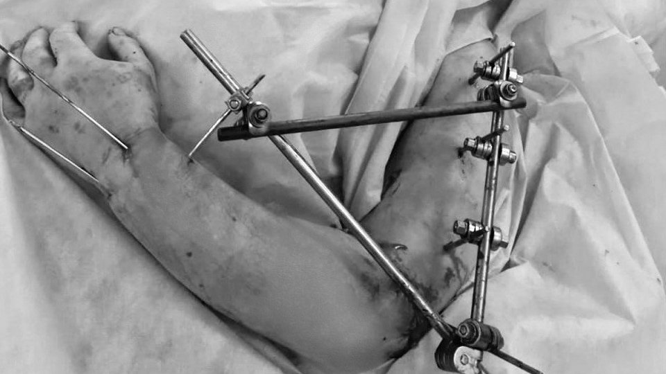 Подмосковные врачи восстановили мужчине руку, которую «зажевал» станок