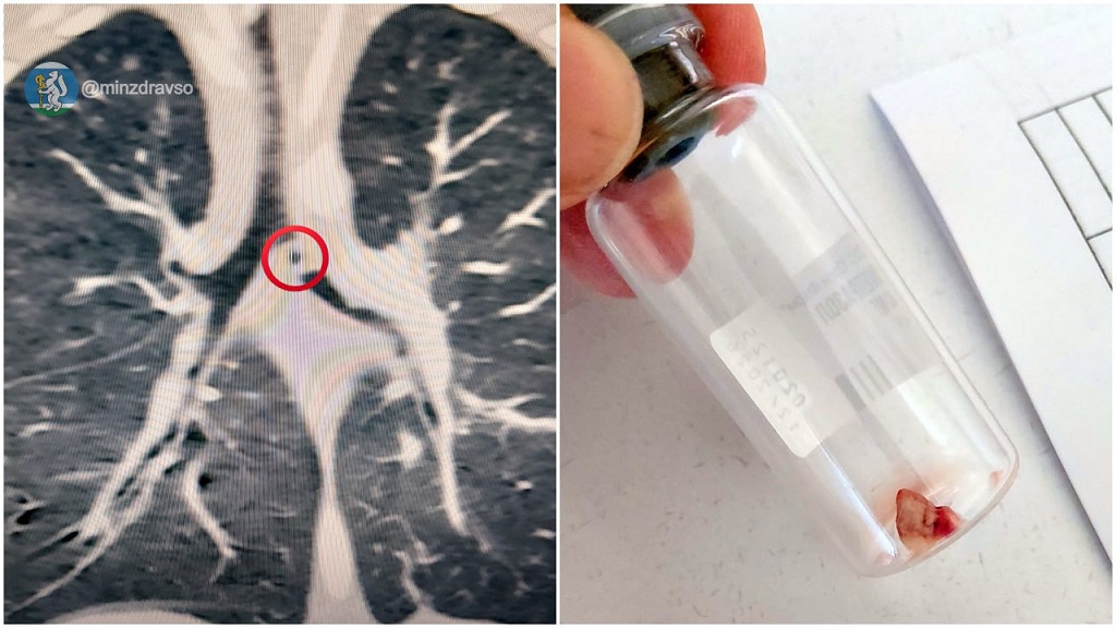 Годовалый ребенок отколупал от бабушкиной печки кусочек глины и чуть не задохнулся (ФОТО)