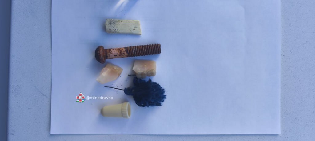 Врачи достали из легкого мужчины металлический колокольчик (ФОТО)