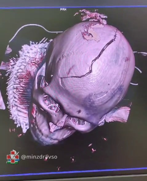 Свердловские врачи спасли уральца, череп которого раскололся на части в момент ДТП (ФОТО)