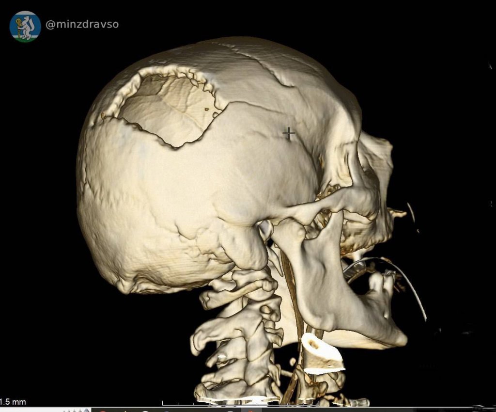 Уральские врачи спасли мужчину, которому проломило череп стрелой строительного крана (ФОТО)