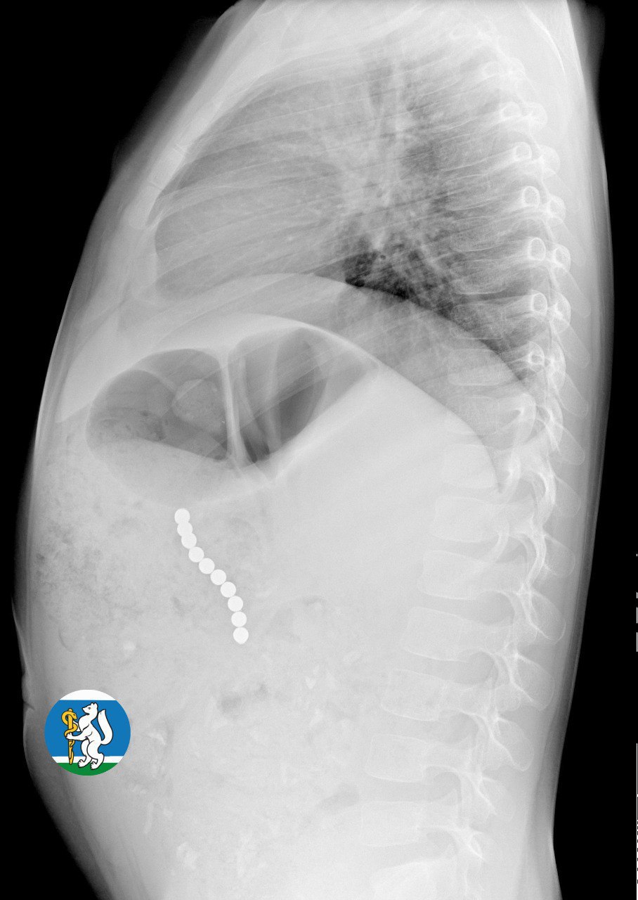 Екатеринбургские врачи спасли девочку, проглотившую 10 магнитных шариков (ФОТО)
