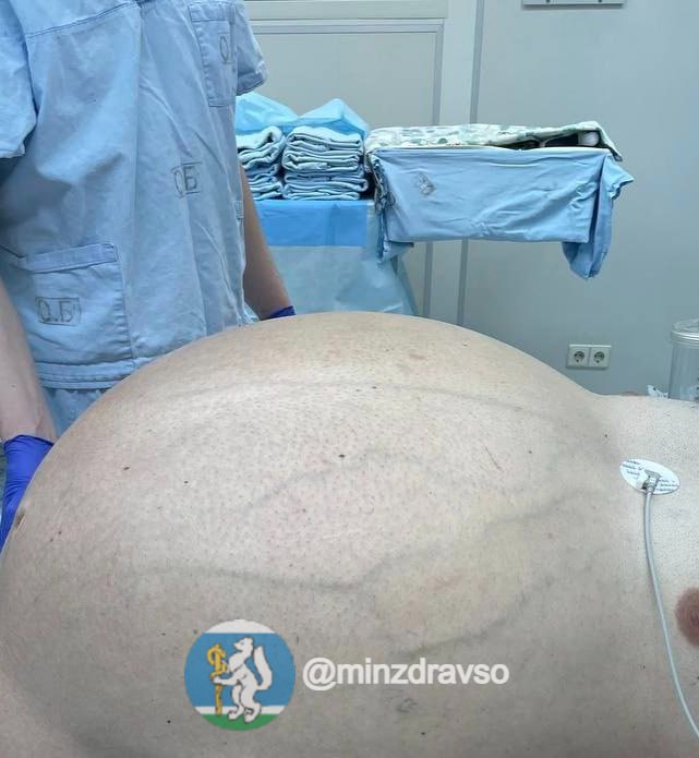 Уральские врачи вырезали из живота пациента гигантскую опухоль массой 60 кг (ФОТО)