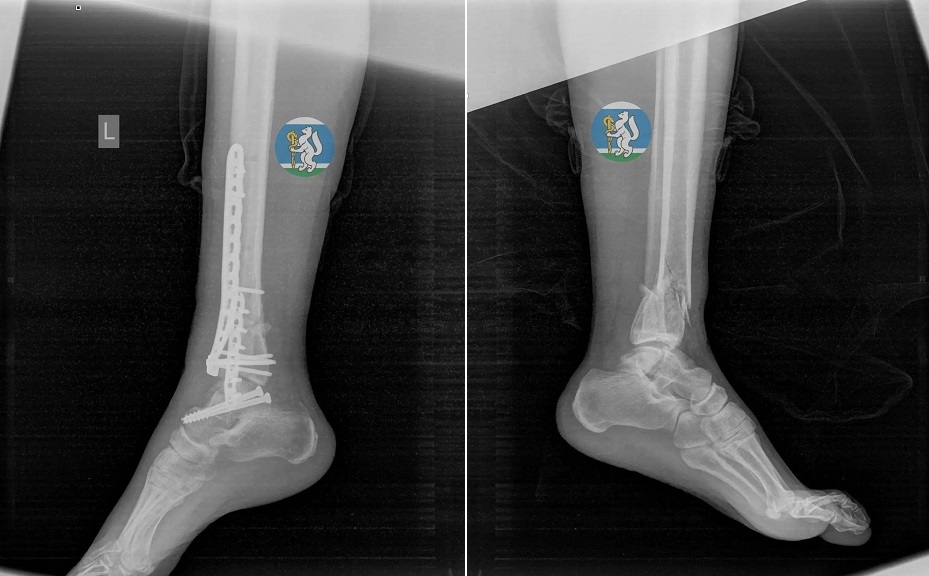 Уральские врачи спасли женщину, упавшую с седьмого этажа