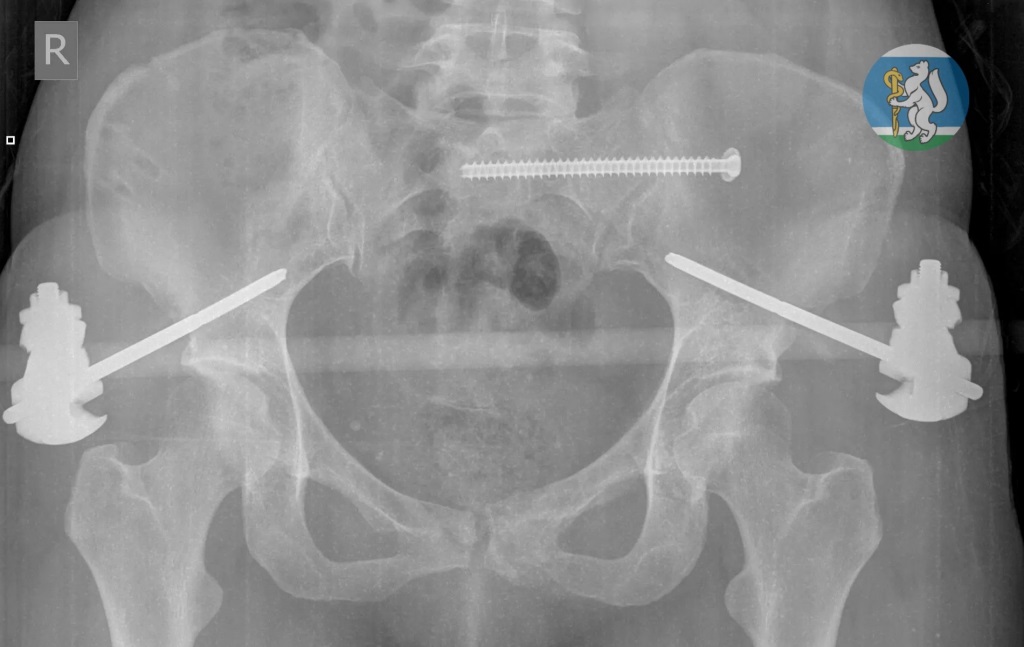 Уральские врачи спасли женщину, упавшую с седьмого этажа